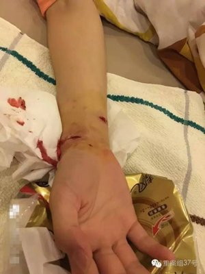  ▲李玲玲在网帖中配图显示，她的手被狗咬的都是血。 受访者供图