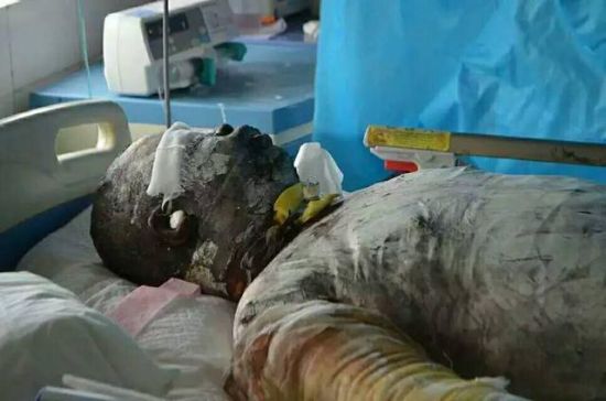 王锋重度烧伤其他居民安全脱险