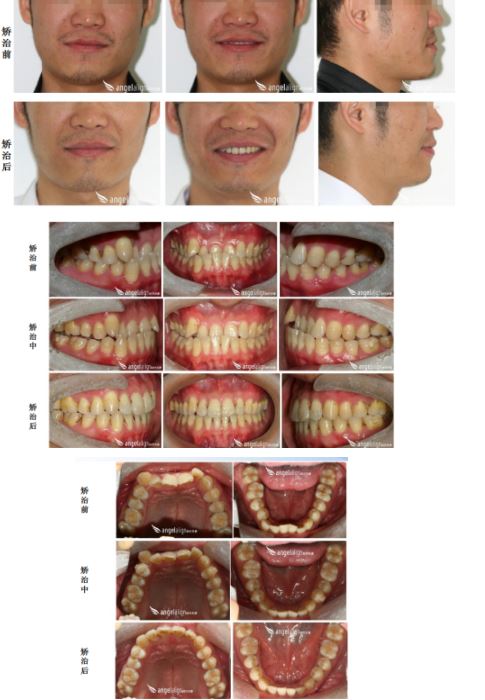 时代天使牙齿深覆合的隐形矫治方法_案例分享