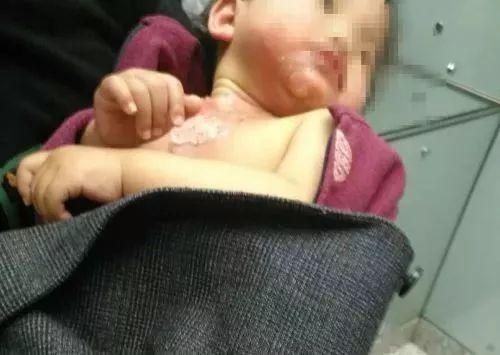 男婴被100℃热水烫伤！这位妈妈的急救连医生都点赞！可当时全家反对