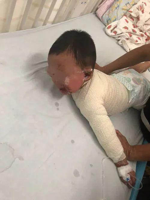 男婴被100℃热水烫伤！这位妈妈的急救连医生都点赞！可当时全家反对