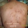 烟台湿疹治疗哪家好/烟台湿疹治疗哪家专业！中医康复医院皮肤科