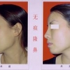 哪里有提供可信赖的隆鼻：临泉隆鼻手术