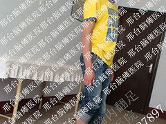 重度马蹄内翻足怎样治疗好|哪里治疗马蹄内翻足图1