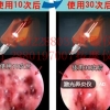 修复“黏膜毯” 治疗鼻炎激光仪厂家激光鼻炎治疗仪品牌理疗工厂