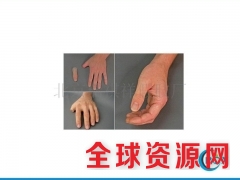 美观手指安装服务_接假手指多少钱_装饰假手_北京瑞祺祥图1