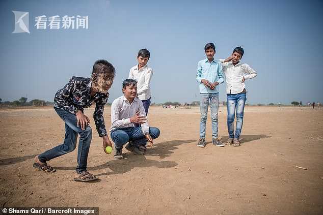 13岁男孩脸上长满浓密毛发如狼人 梦想是当警察