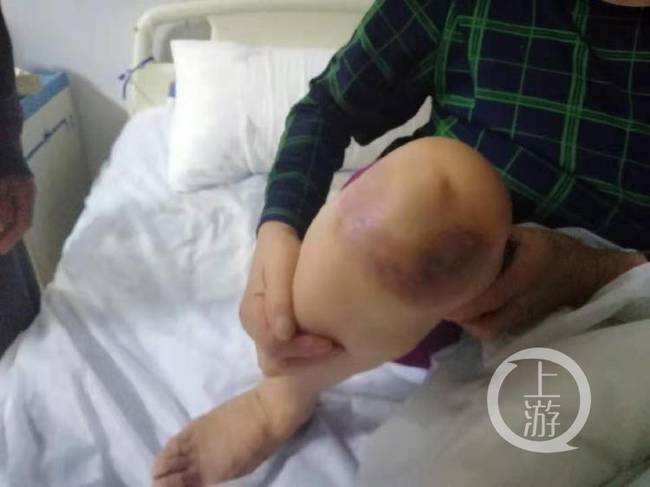 河南杞县115人针灸后皮肤溃烂 医生被警方带走